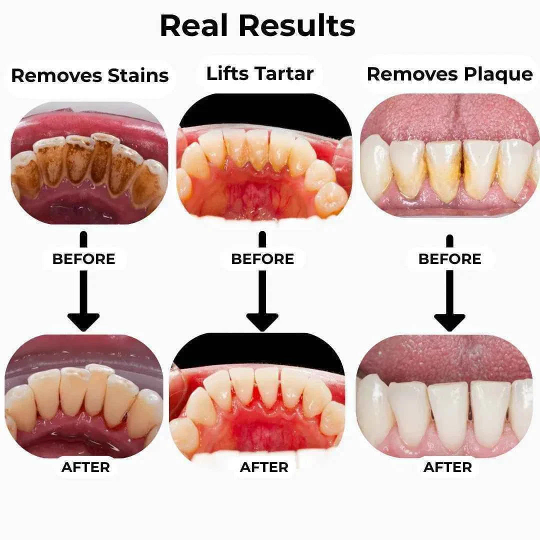 M1 Ultrasonic Tooth Cleaner | Professional Plaque & Tartar Removal